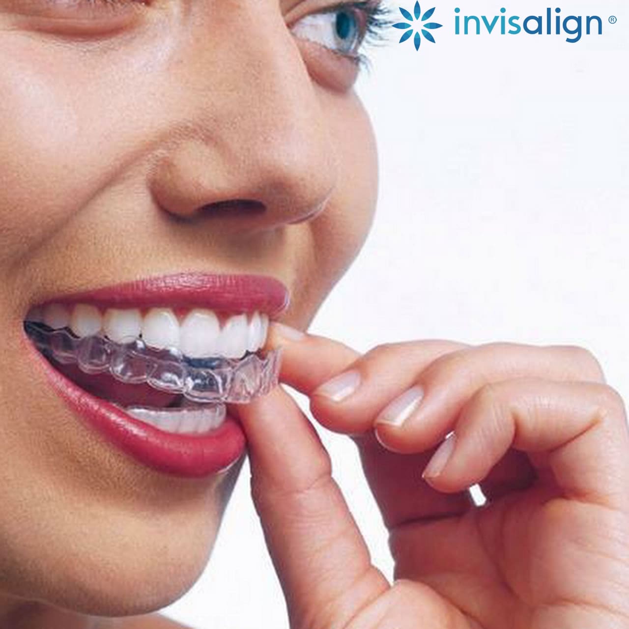 Invisalign - Ortodoncia Invisible en Málaga