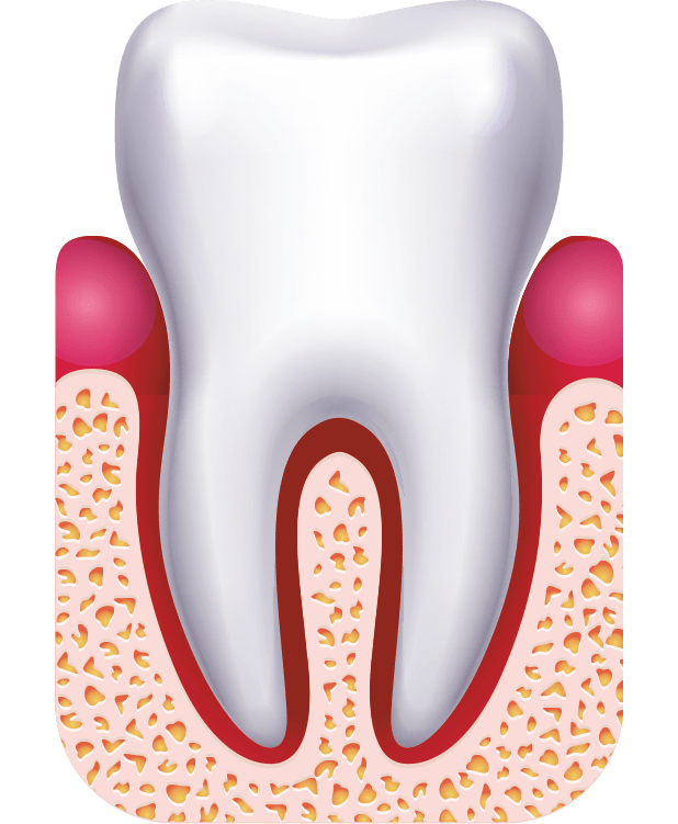 Tratamiento de Gingivitis en Málaga