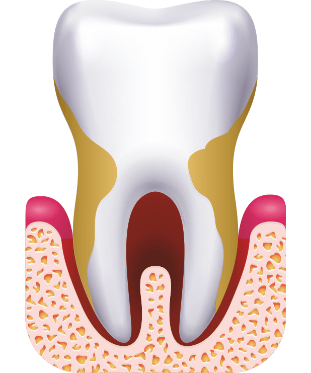 Tratamiento de Periodontitis en Málaga