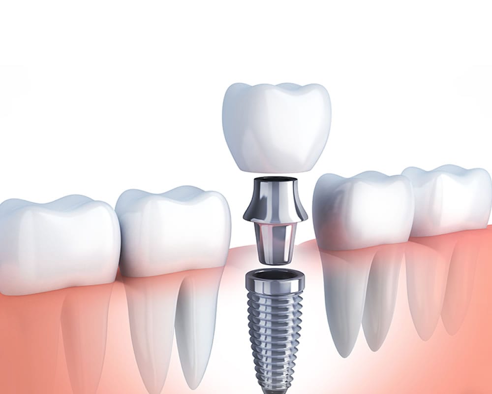 implante dental v2 min