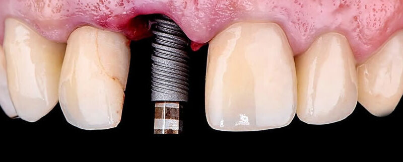 implantes-min4